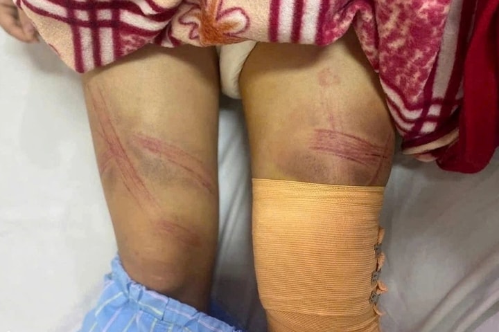 Xác minh vụ nữ sinh lớp 7 bị bố đánh phải nhập viện