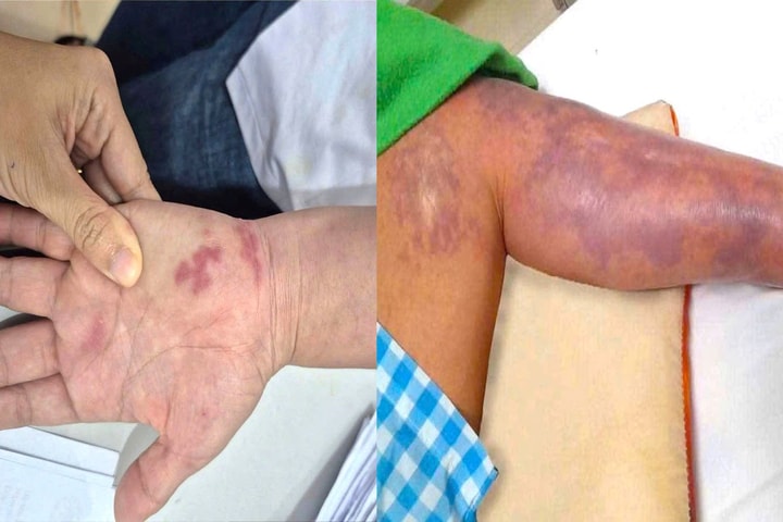 Cụ ông 70 tuổi nhập viện khẩn cấp vì bị vây cá đâm