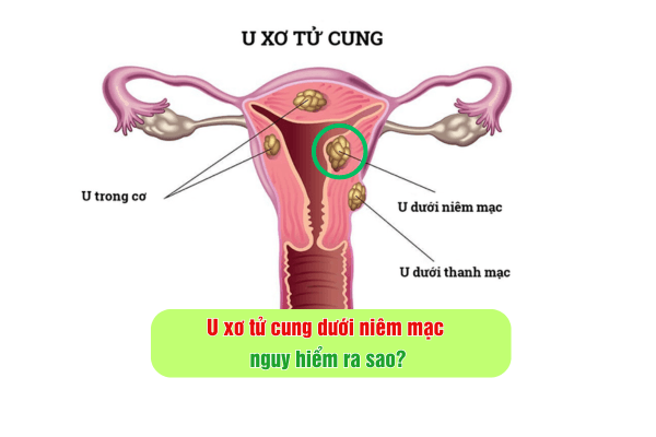 U xơ tử cung dưới niêm mạc nguy hiểm ra sao?