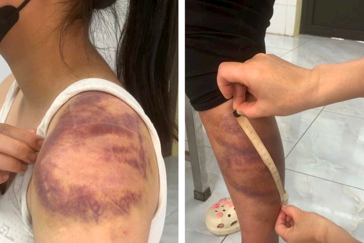 Khởi tố người chồng bạo hành vợ đang mang thai và con nhỏ