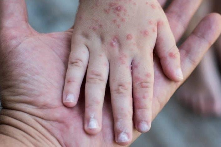 Siết kiểm soát tay chân miệng, chủ động ứng phó từ cơ sở