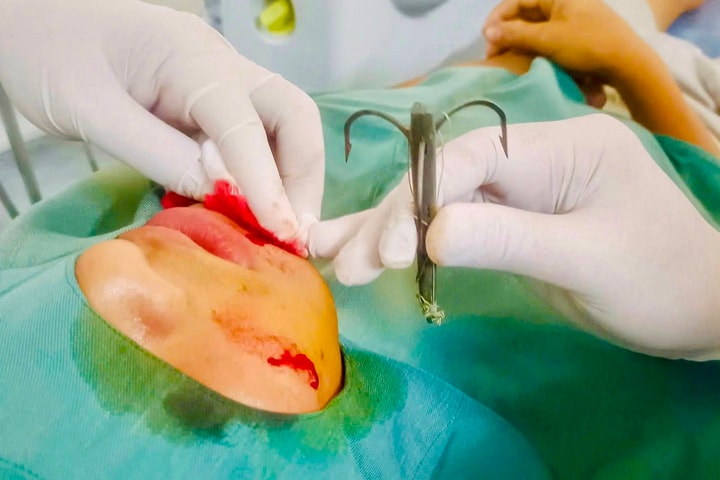 Lưỡi câu móc sâu vào mặt nam sinh 15 tuổi ở Nghệ An