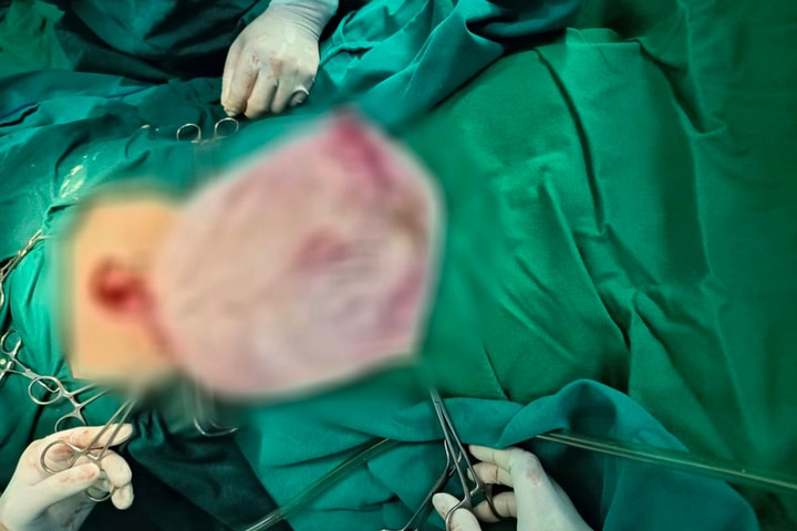 Khối u khổng lồ chứa hơn 7 lít dịch trong bụng thiếu nữ 16 tuổi