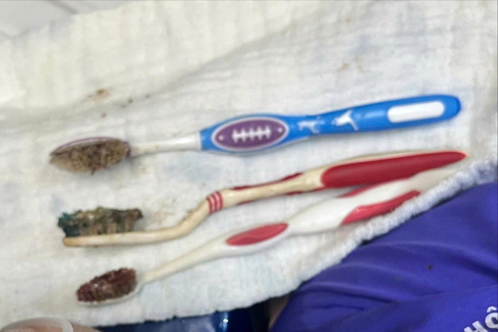 Nội soi thành công ca nuốt 3 bàn chải đánh răng hiếm gặp