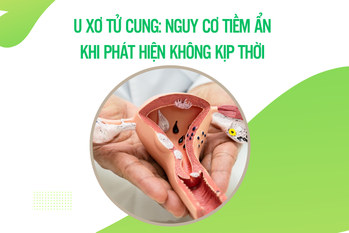 U xơ tử cung: Nguy cơ tiềm ẩn khi phát hiện không kịp thời