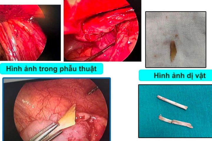 Trẻ 48 tháng tuổi bị xương lợn đâm thủng ruột