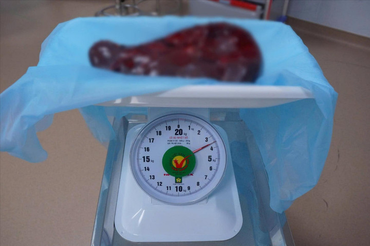 Phẫu thuật cắt lá lách “khổng lồ” 3,5 kg chèn ép trong ổ bụng