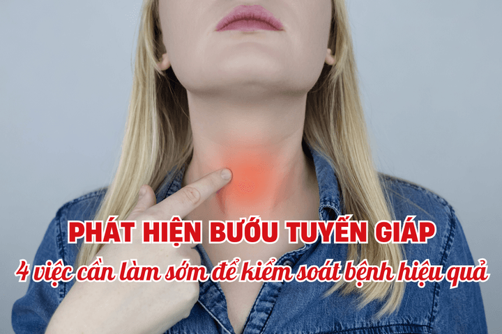 Phát hiện bướu tuyến giáp: 4 việc cần làm sớm để kiểm soát bệnh hiệu quả