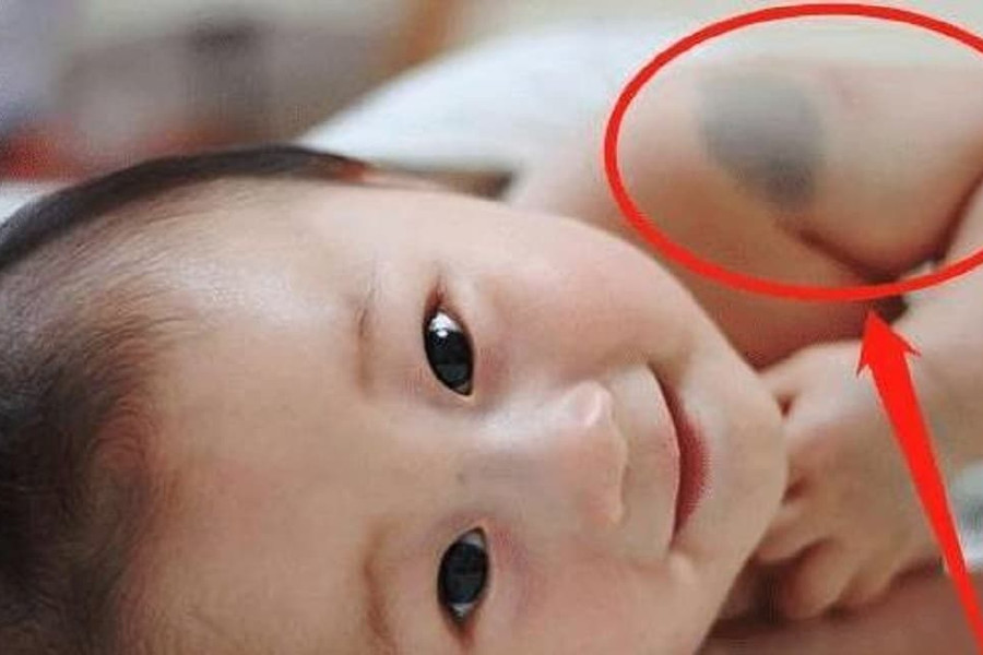 Ngoài di truyền, nguyên nhân khiến trẻ có vết bớt thì 3 hành vi này khi mang thai cũng là một trong những 'thủ phạm'