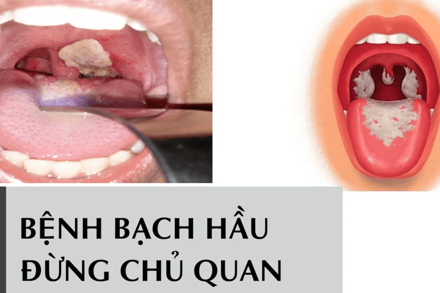 Tỷ lệ tiêm vắc xin bạch hầu tăng đột biến