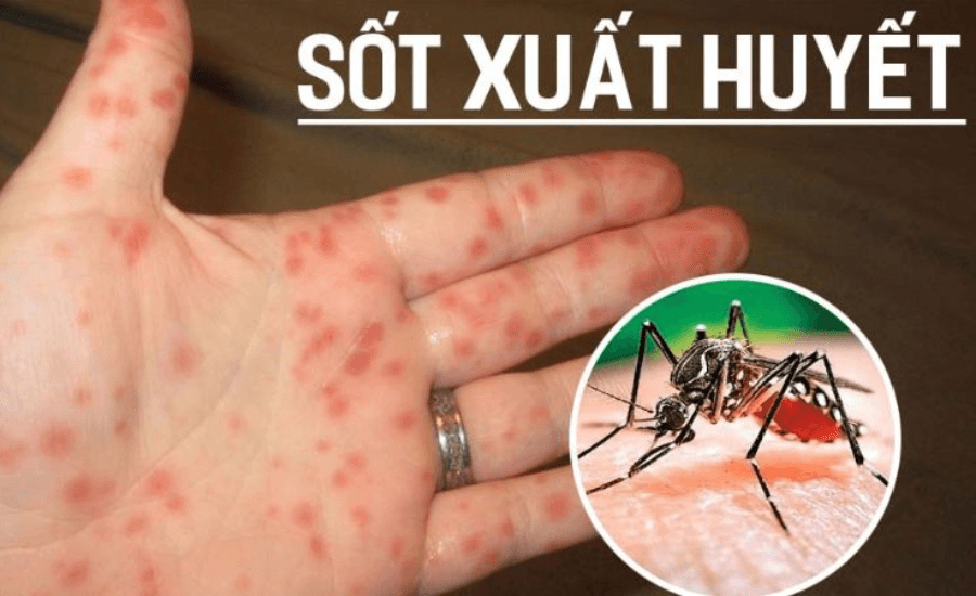 Hà Nội thêm nhiều ca sốt xuất huyết và ho gà