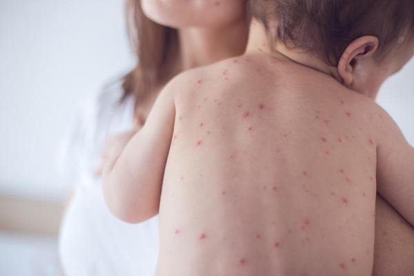 TP. HCM chính thức công bố dịch sởi
