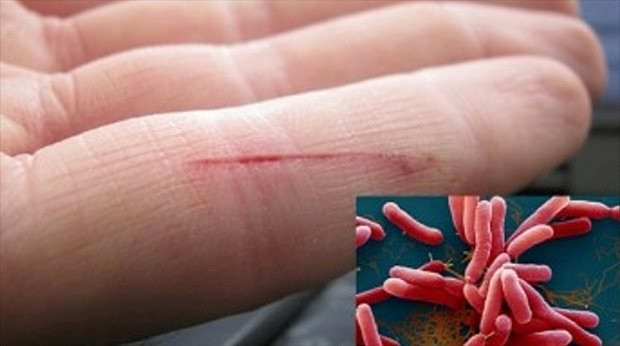 Đã có người nhiễm vi khuẩn “ăn thịt” sau lũ