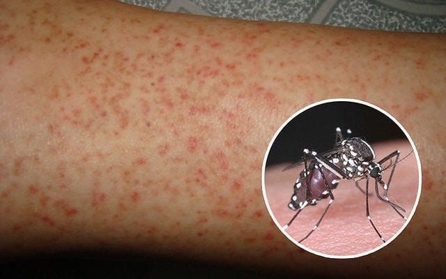 Gia tăng ca mắc sốt xuất huyết: Cảnh báo nguy cơ biến chứng nặng do chủng virus Den-2