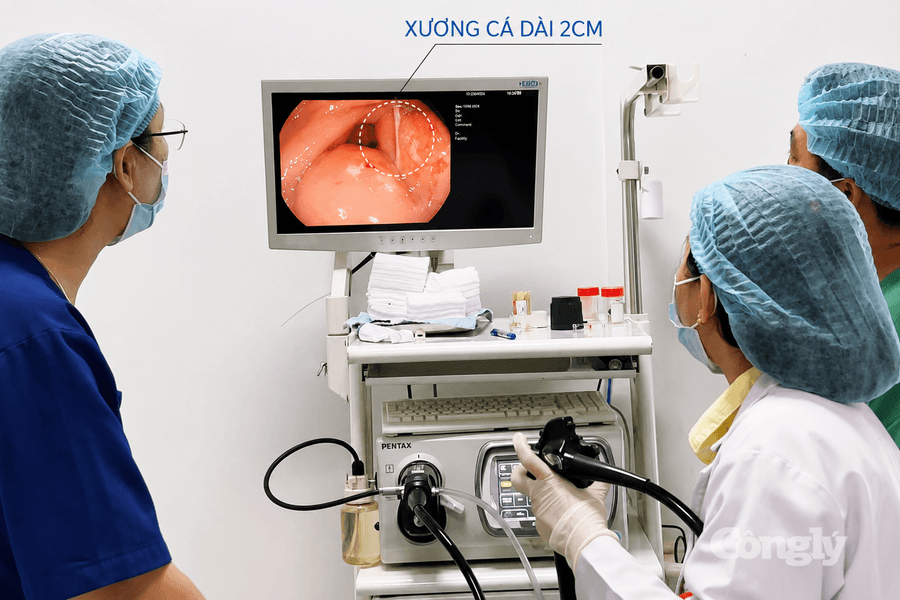 Gắp xương cá cắm sâu trong dạ dày bệnh nhân 70 tuổi