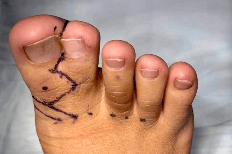 Bệnh nhi bị dị tật dính ngón chân hiếm gặp